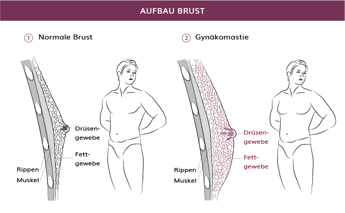 Aufbau Brust bei Gynäkomastie, München, Dr. Barbara Kernt 