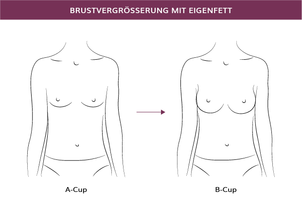 Brustvergrößerung mit Eigenfett in München, Dr. Barbara Kernt  
