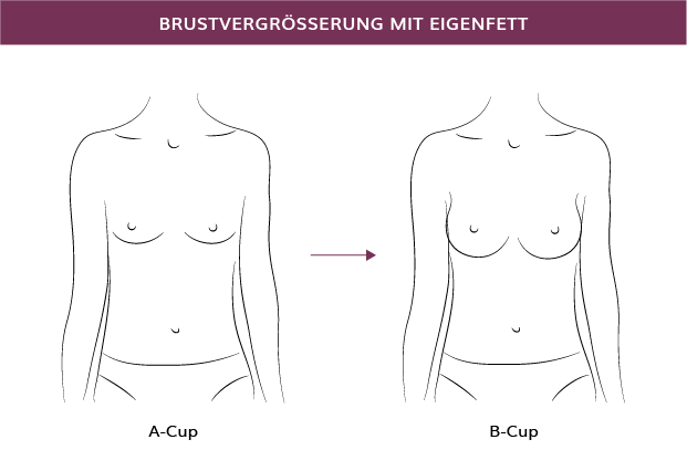 Brustvergrößerung mit Eigenfett in München, Dr. Barbara Kernt 