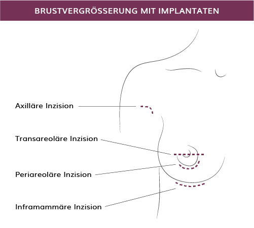 Brustvergrößerung mit Implantaten in München, Dr. Barbara Kernt  
