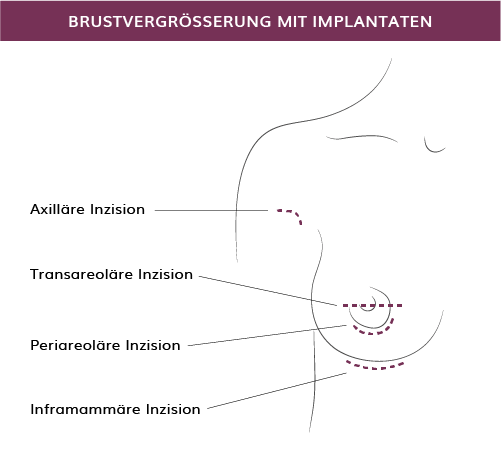 Brustvergrößerung mit Implantaten in München, Dr. Barbara Kernt 