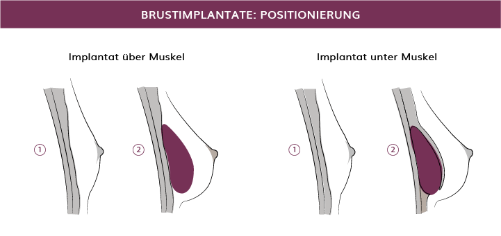 Brustvergrößerung, Positionierung der Implantate, München, Dr. Barbara Kernt 