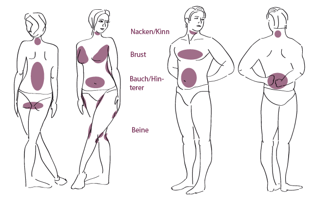Fettabsaugung München - Graphik Problemzonen Dr. Barbara Kernt 