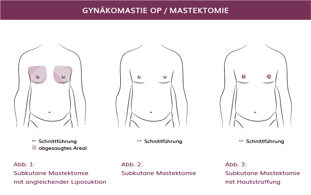 Gynäkomastie-Operation in München, Dr. Barbara Kernt 