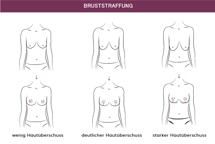 kernt_graphik_bruststraffung.png 