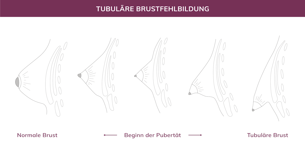 Tubuläre Brustfehlbildung in München, Dr. Barbara Kernt 